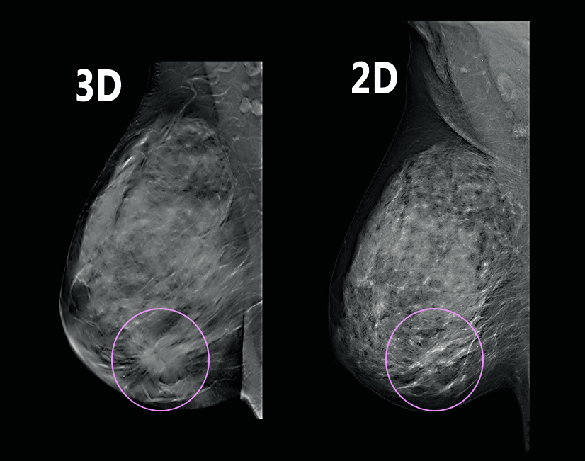 Southwest Health The Benefits Of 3d Mammograms And The Importance Of