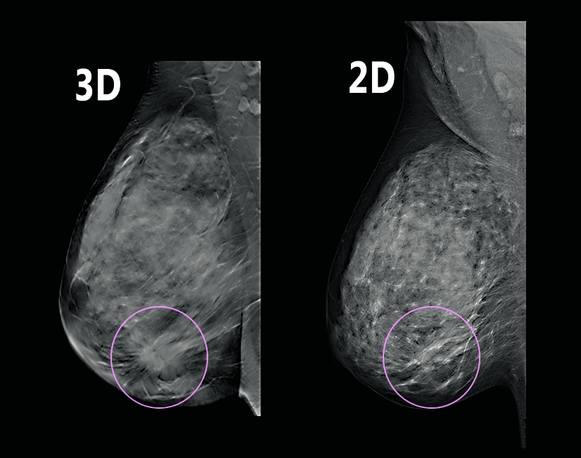 breast cancer digital mammogram